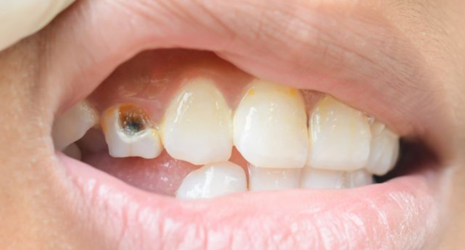 cara mengatasi bau mulut akibat gigi berlubang
